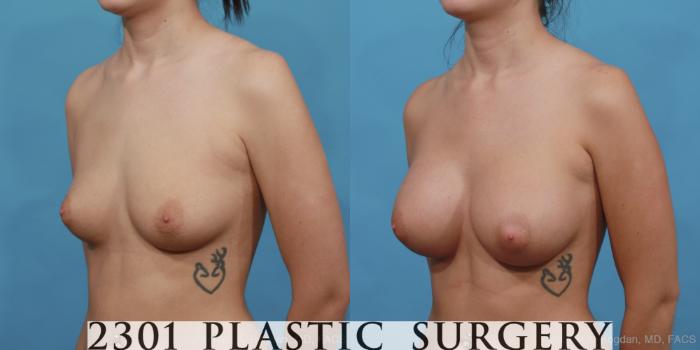 Before & After Silicone Implants Case 467 View #2 View in Fort Worth, Plano, & Frisco, Texas