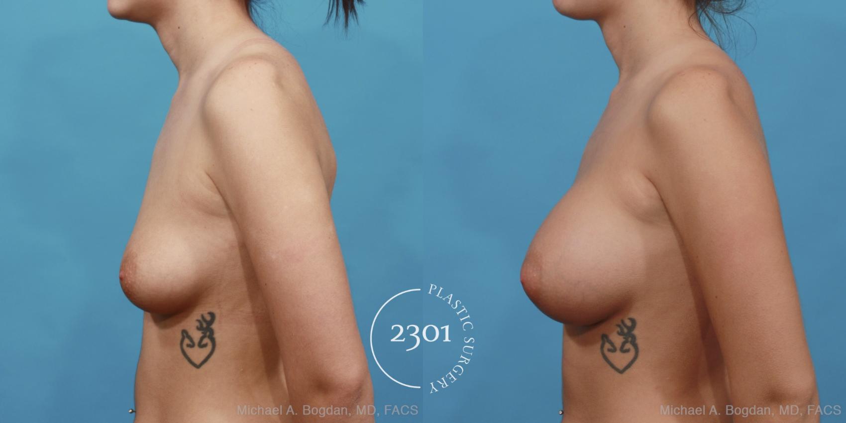 Before & After Silicone Implants Case 467 View #3 View in Fort Worth, Plano, & Frisco, Texas