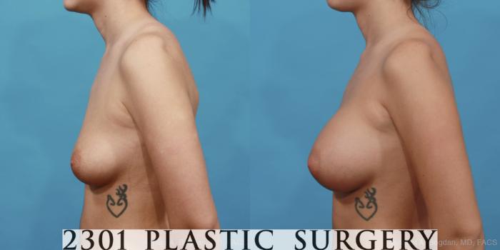 Before & After Silicone Implants Case 467 View #3 View in Fort Worth, Plano, & Frisco, Texas
