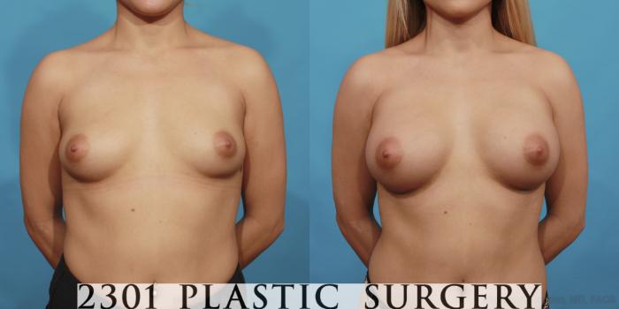 Before & After Silicone Implants Case 472 View #1 View in Fort Worth, Plano, & Frisco, Texas