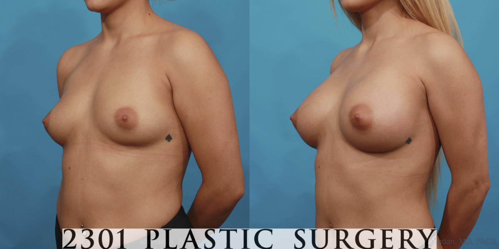Before & After Silicone Implants Case 472 View #2 View in Fort Worth & Frisco, Texas