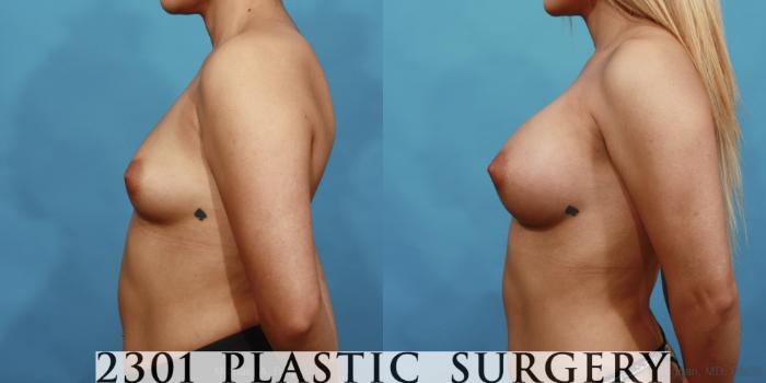 Before & After Silicone Implants Case 472 View #3 View in Fort Worth, Plano, & Frisco, Texas