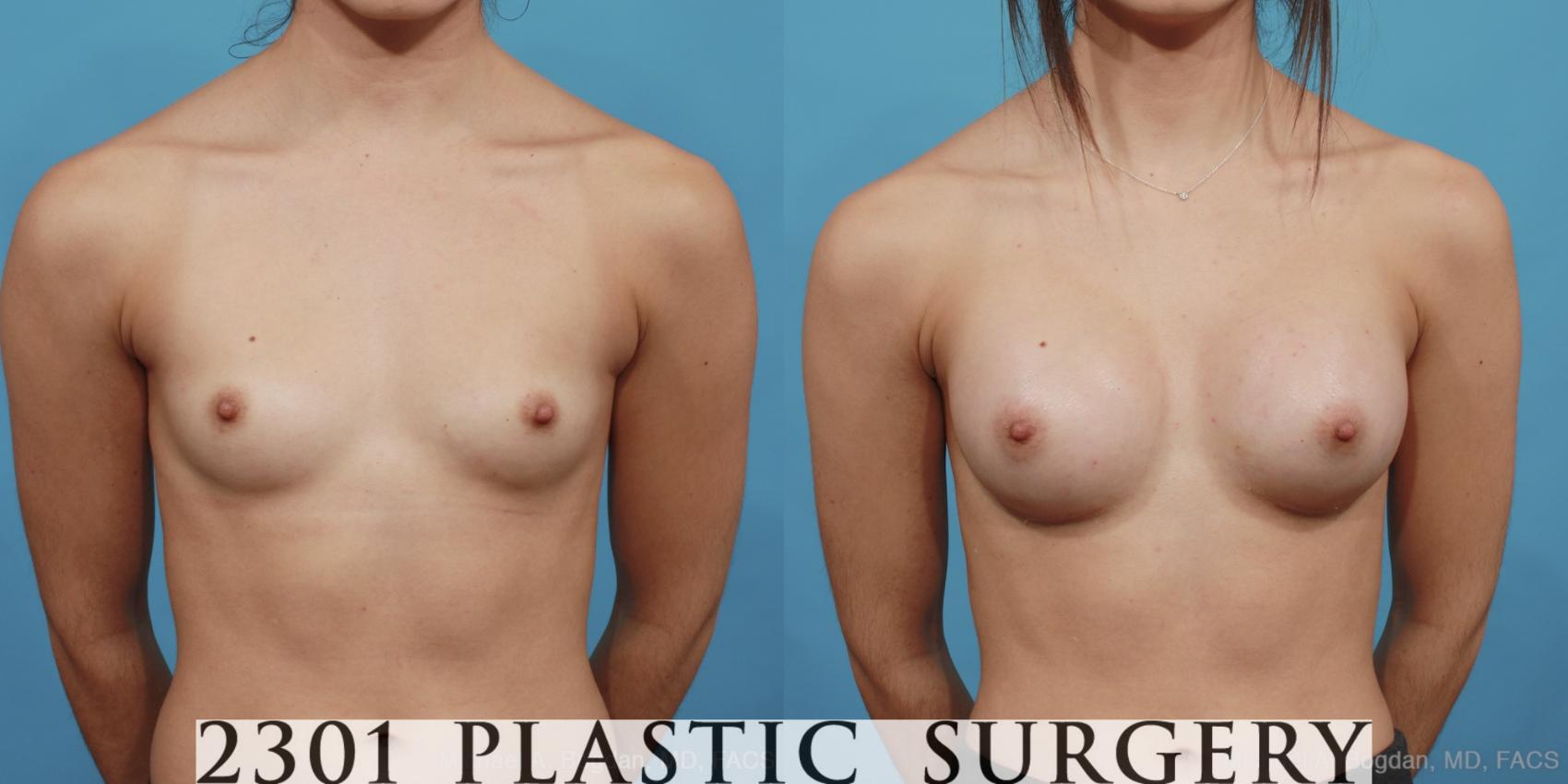 Before & After Silicone Implants Case 473 View #1 View in Fort Worth & Frisco, Texas