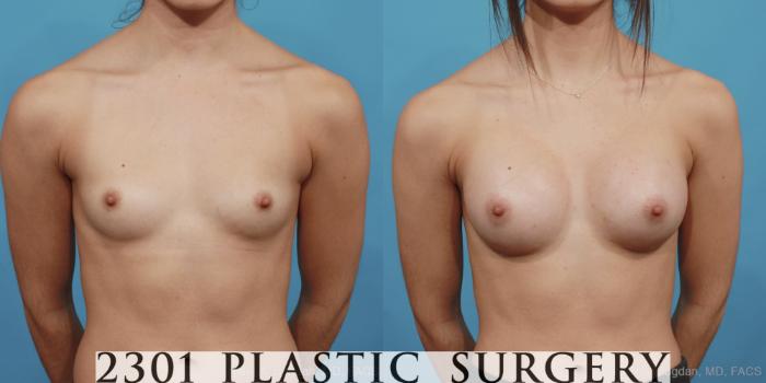 Before & After Silicone Implants Case 473 View #1 View in Fort Worth, Plano, & Frisco, Texas