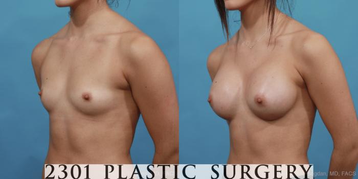 Before & After Silicone Implants Case 473 View #2 View in Fort Worth, Plano, & Frisco, Texas