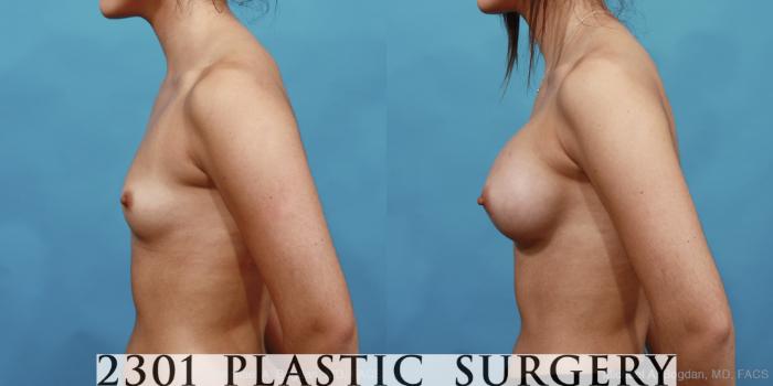 Before & After Silicone Implants Case 473 View #3 View in Fort Worth, Plano, & Frisco, Texas