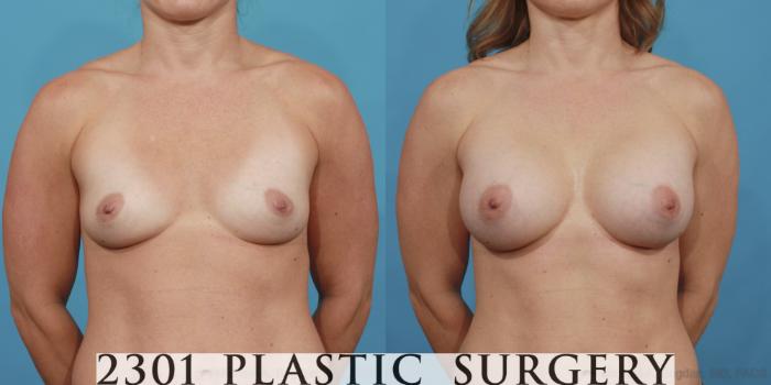 Before & After Breast Augmentation Case 474 View #1 View in Fort Worth, Plano, & Frisco, Texas