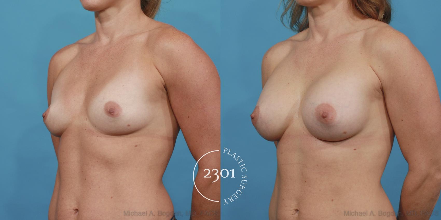 Before & After Silicone Implants Case 474 View #2 View in Fort Worth, Plano, & Frisco, Texas