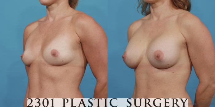 Before & After Breast Augmentation Case 474 View #2 View in Fort Worth, Plano, & Frisco, Texas