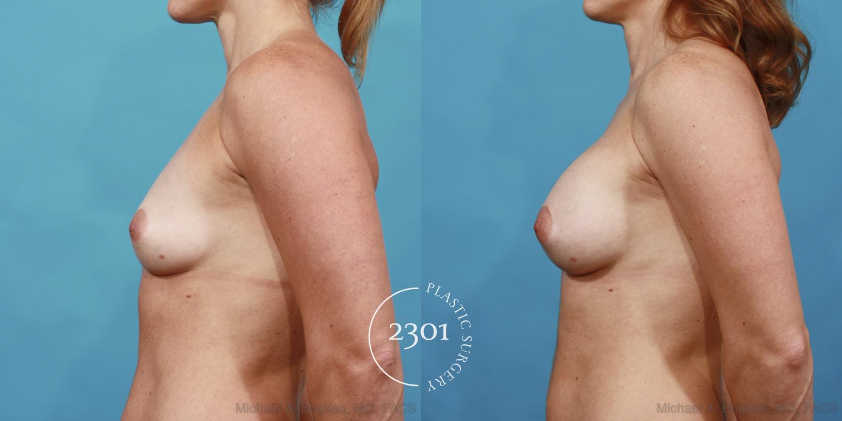 Before & After Silicone Implants Case 474 View #3 View in Fort Worth, Plano, & Frisco, Texas