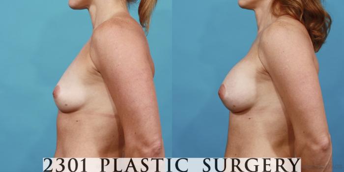 Before & After Silicone Implants Case 474 View #3 View in Fort Worth, Plano, & Frisco, Texas
