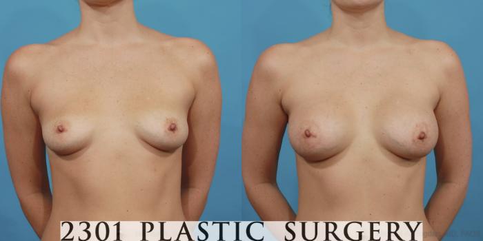 Before & After Silicone Implants Case 478 View #1 View in Fort Worth, Plano, & Frisco, Texas