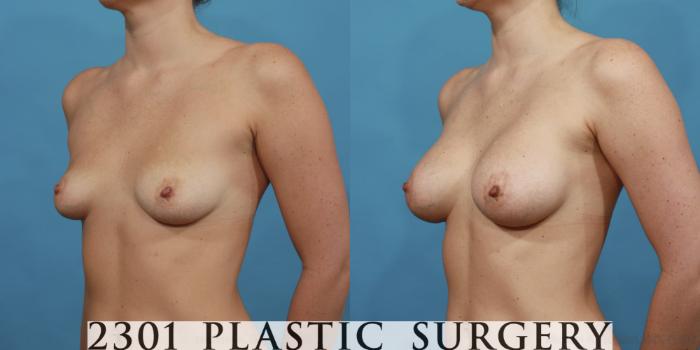Before & After Silicone Implants Case 478 View #2 View in Fort Worth, Plano, & Frisco, Texas