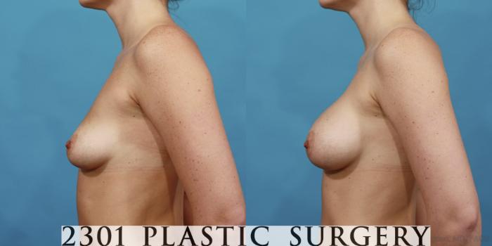 Before & After Silicone Implants Case 478 View #3 View in Fort Worth, Plano, & Frisco, Texas
