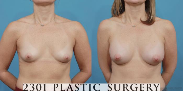Before & After Silicone Implants Case 484 View #1 View in Fort Worth, Plano, & Frisco, Texas