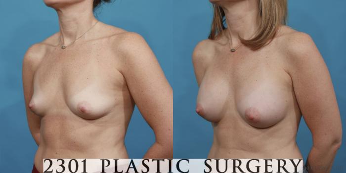 Before & After Silicone Implants Case 484 View #2 View in Fort Worth, Plano, & Frisco, Texas