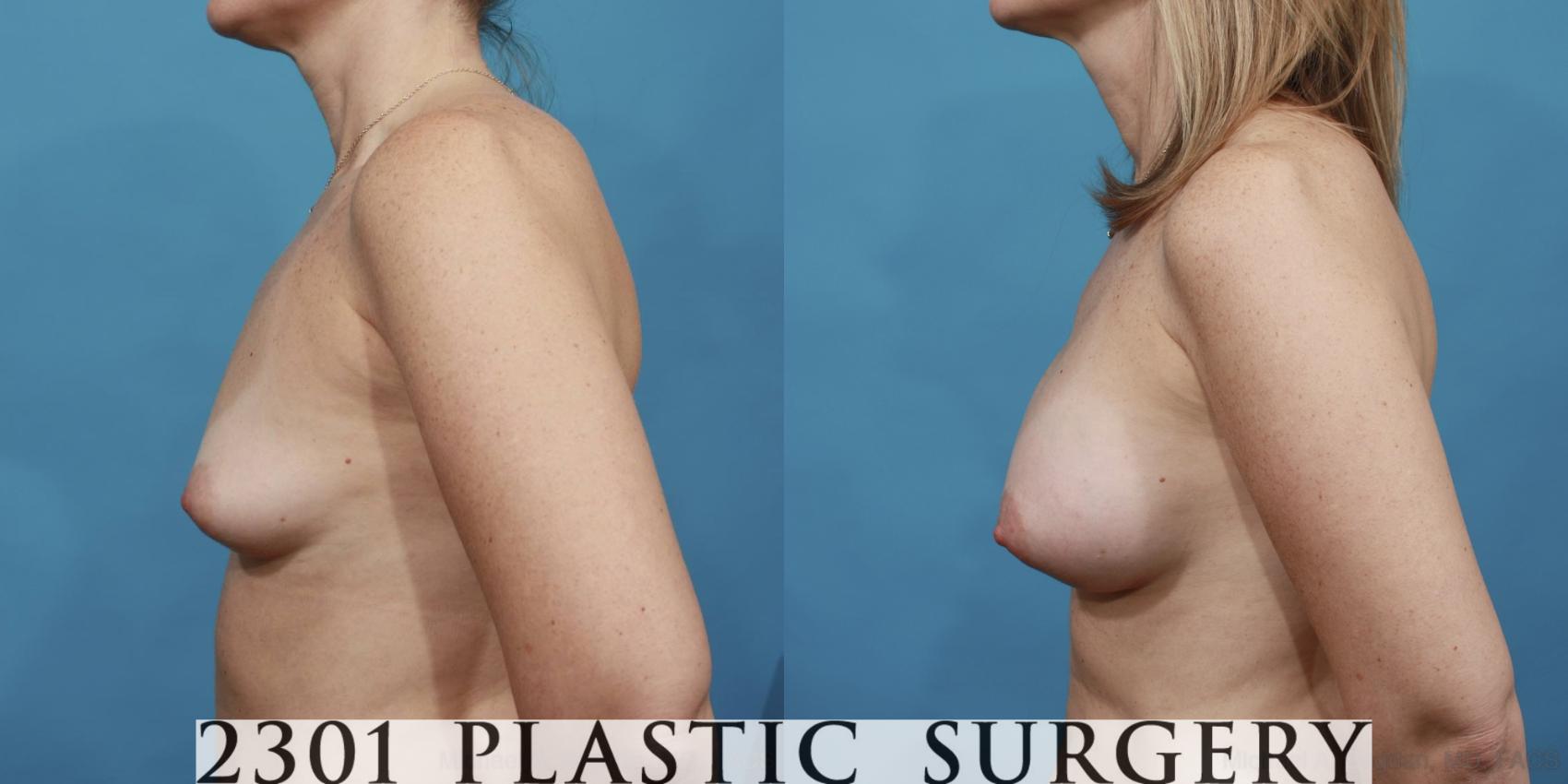 Before & After Silicone Implants Case 484 View #3 View in Fort Worth & Frisco, Texas