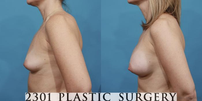 Before & After Silicone Implants Case 484 View #3 View in Fort Worth, Plano, & Frisco, Texas