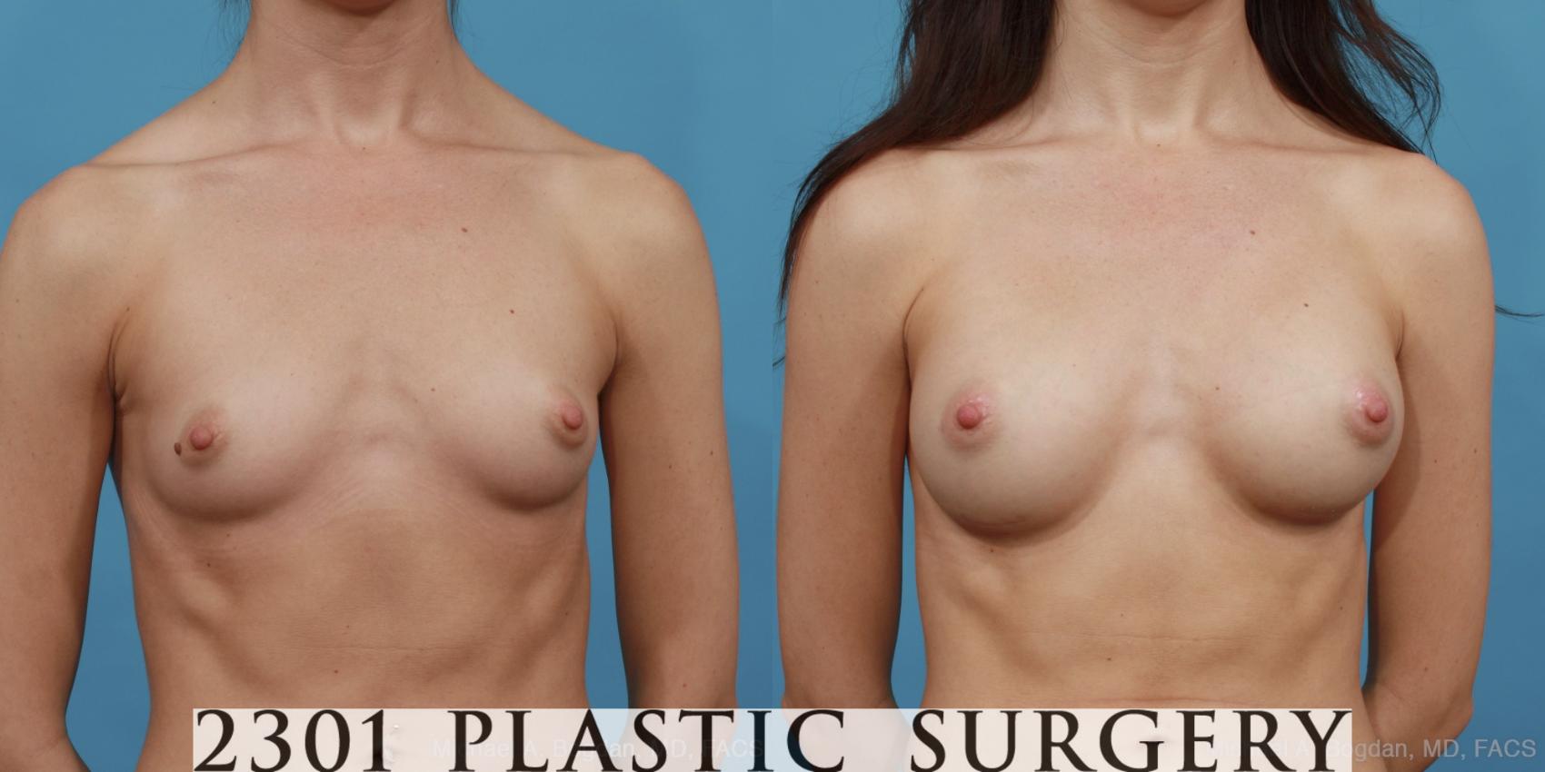 Before & After Breast Augmentation Case 487 View #1 View in Fort Worth, Plano, & Frisco, Texas
