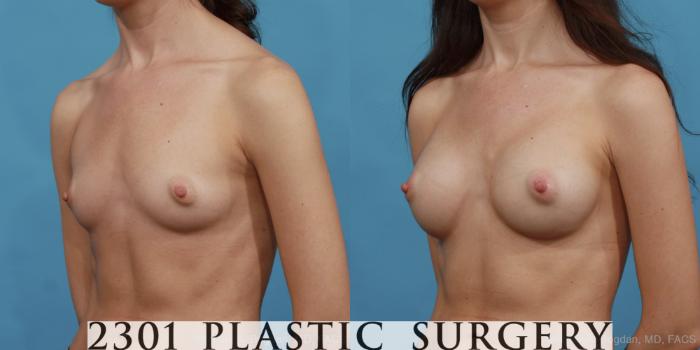 Before & After Silicone Implants Case 487 View #2 View in Fort Worth, Plano, & Frisco, Texas