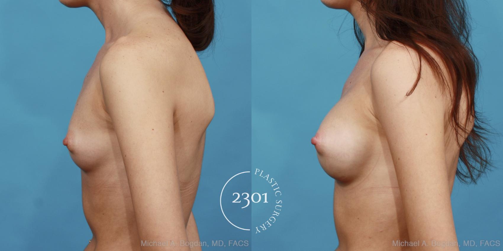 Before & After Silicone Implants Case 487 View #3 View in Fort Worth, Plano, & Frisco, Texas