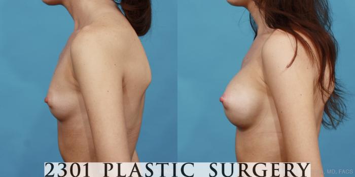 Before & After Silicone Implants Case 487 View #3 View in Fort Worth, Plano, & Frisco, Texas