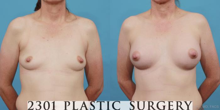 Before & After Silicone Implants Case 488 View #1 View in Fort Worth, Plano, & Frisco, Texas