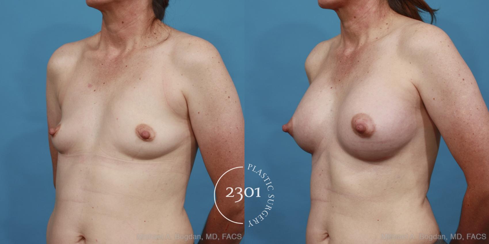 Before & After Silicone Implants Case 488 View #2 View in Fort Worth, Plano, & Frisco, Texas