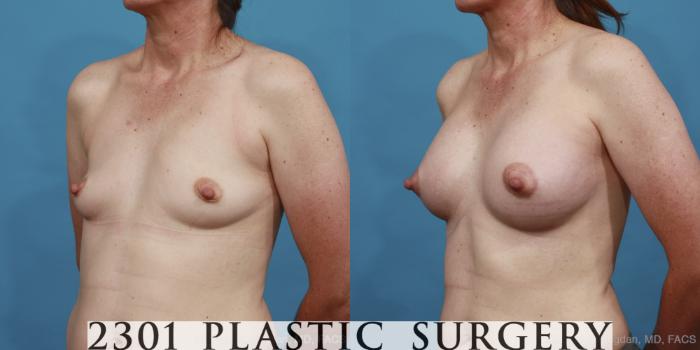 Before & After Silicone Implants Case 488 View #2 View in Fort Worth, Plano, & Frisco, Texas