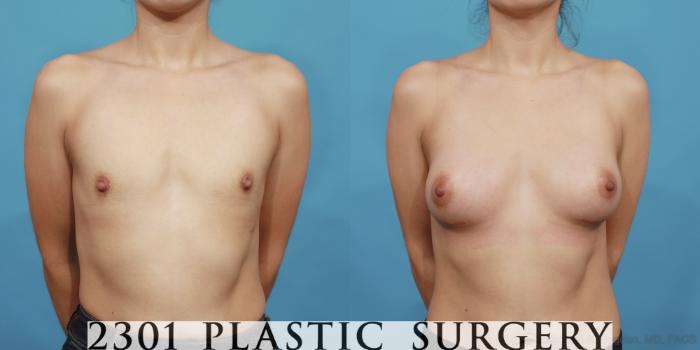 Before & After Silicone Implants Case 491 View #1 View in Fort Worth, Plano, & Frisco, Texas