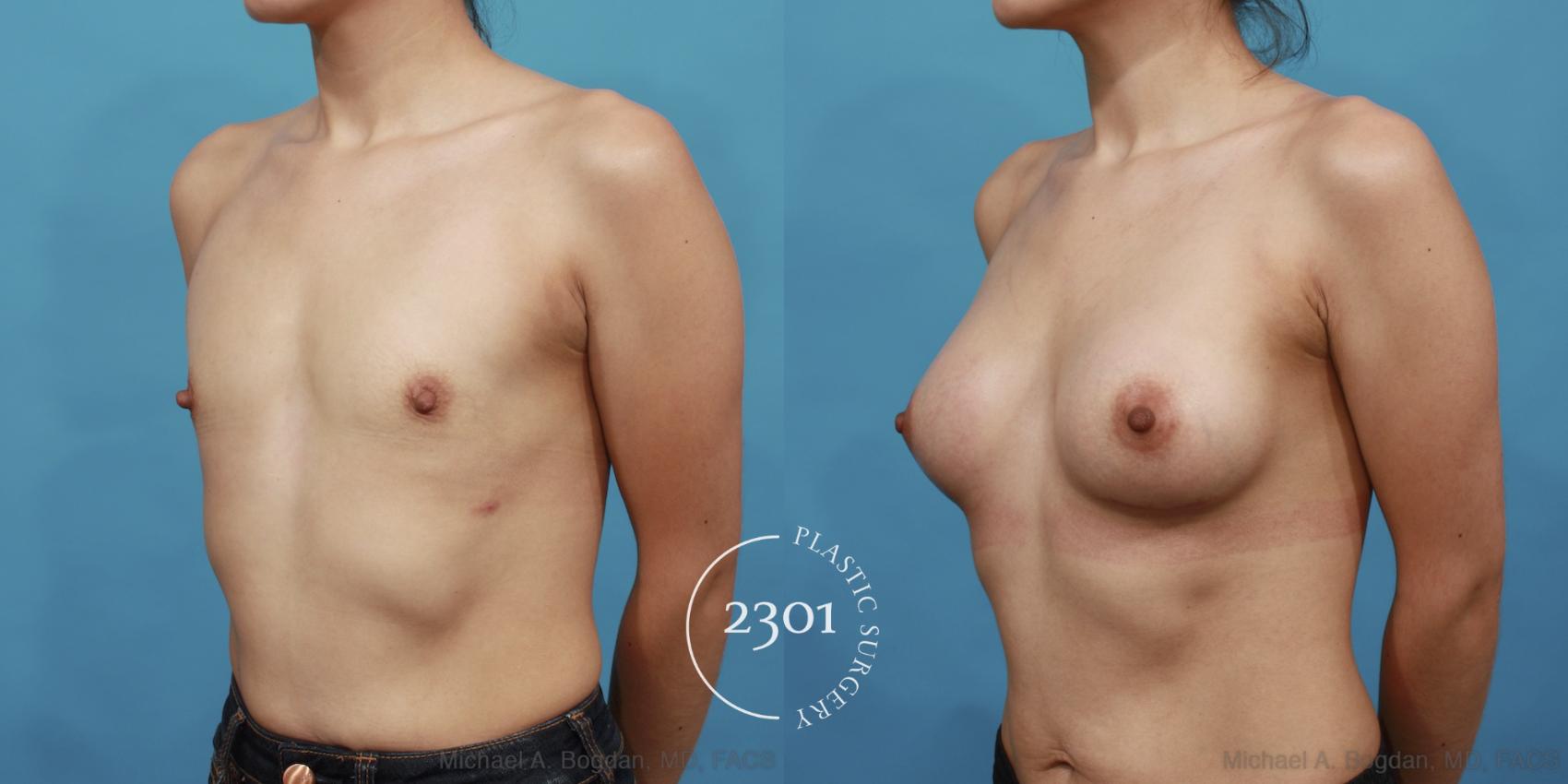 Before & After Silicone Implants Case 491 View #2 View in Fort Worth, Plano, & Frisco, Texas