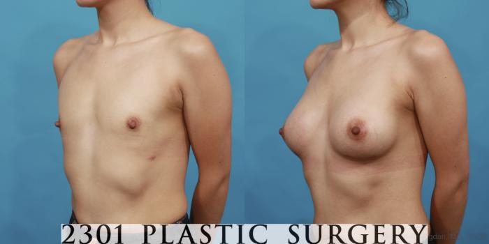 Before & After Silicone Implants Case 491 View #2 View in Fort Worth, Plano, & Frisco, Texas