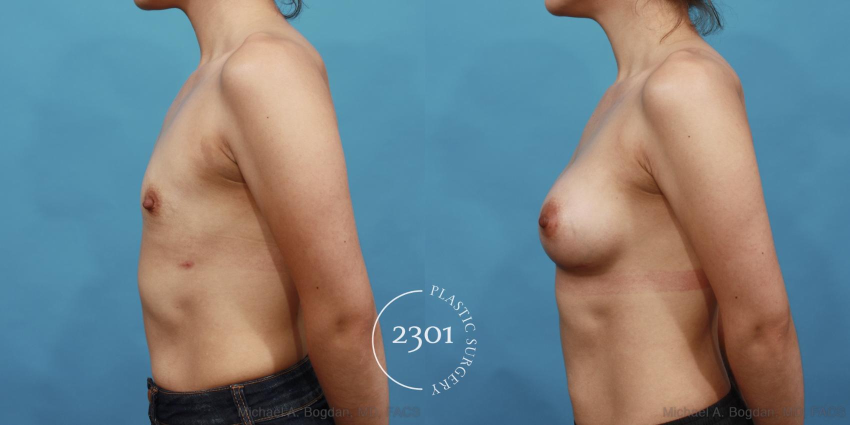 Before & After Silicone Implants Case 491 View #3 View in Fort Worth, Plano, & Frisco, Texas