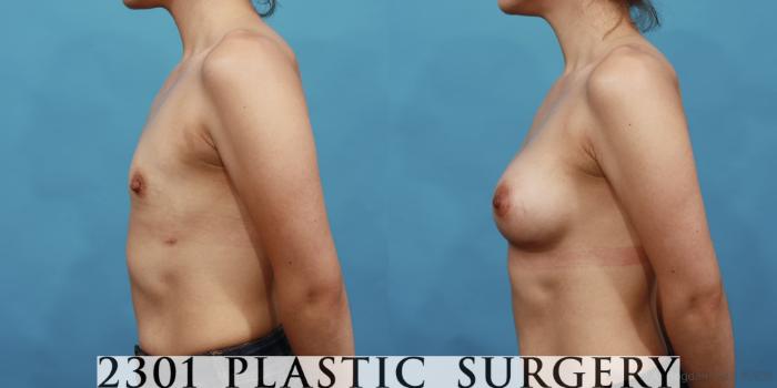 Before & After Silicone Implants Case 491 View #3 View in Fort Worth, Plano, & Frisco, Texas