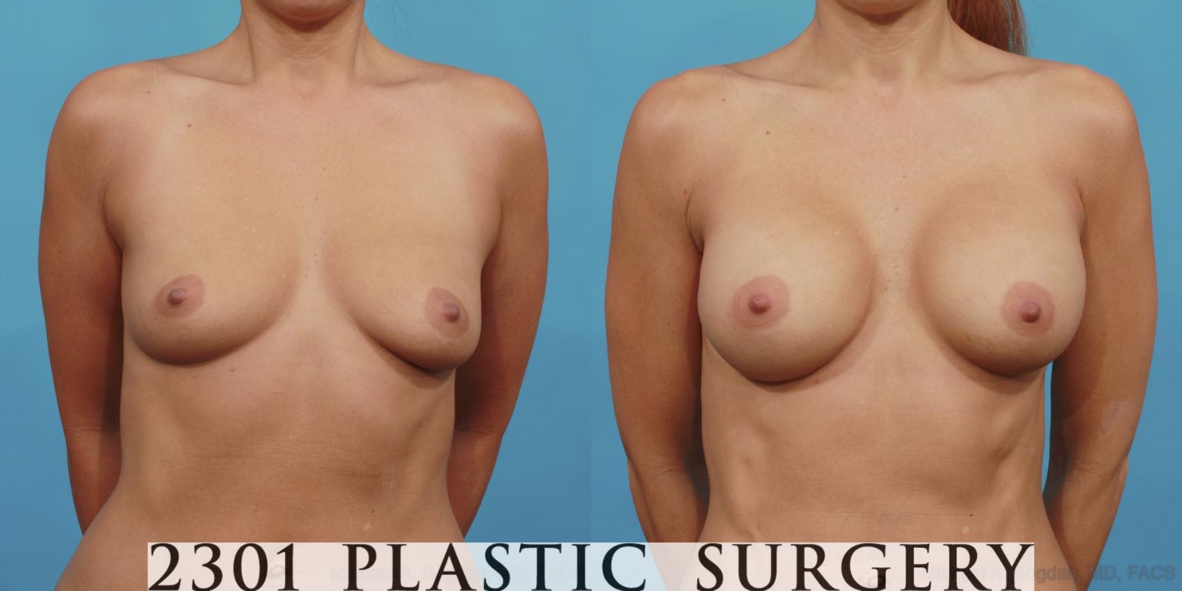 Before & After Breast Augmentation Case 494 View #1 View in Fort Worth, Plano, & Frisco, Texas