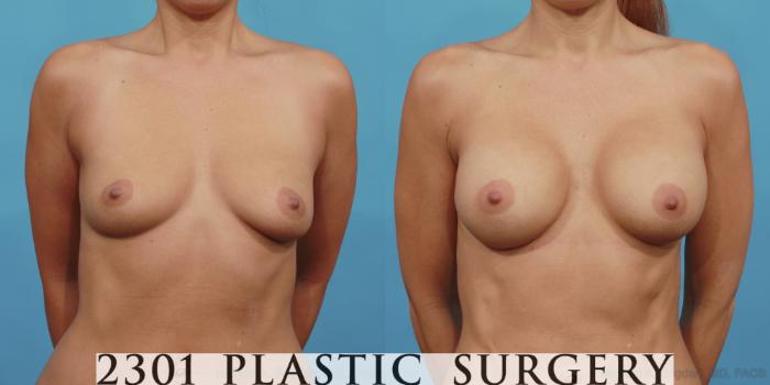 Before & After Silicone Implants Case 494 View #1 View in Fort Worth, Plano, & Frisco, Texas