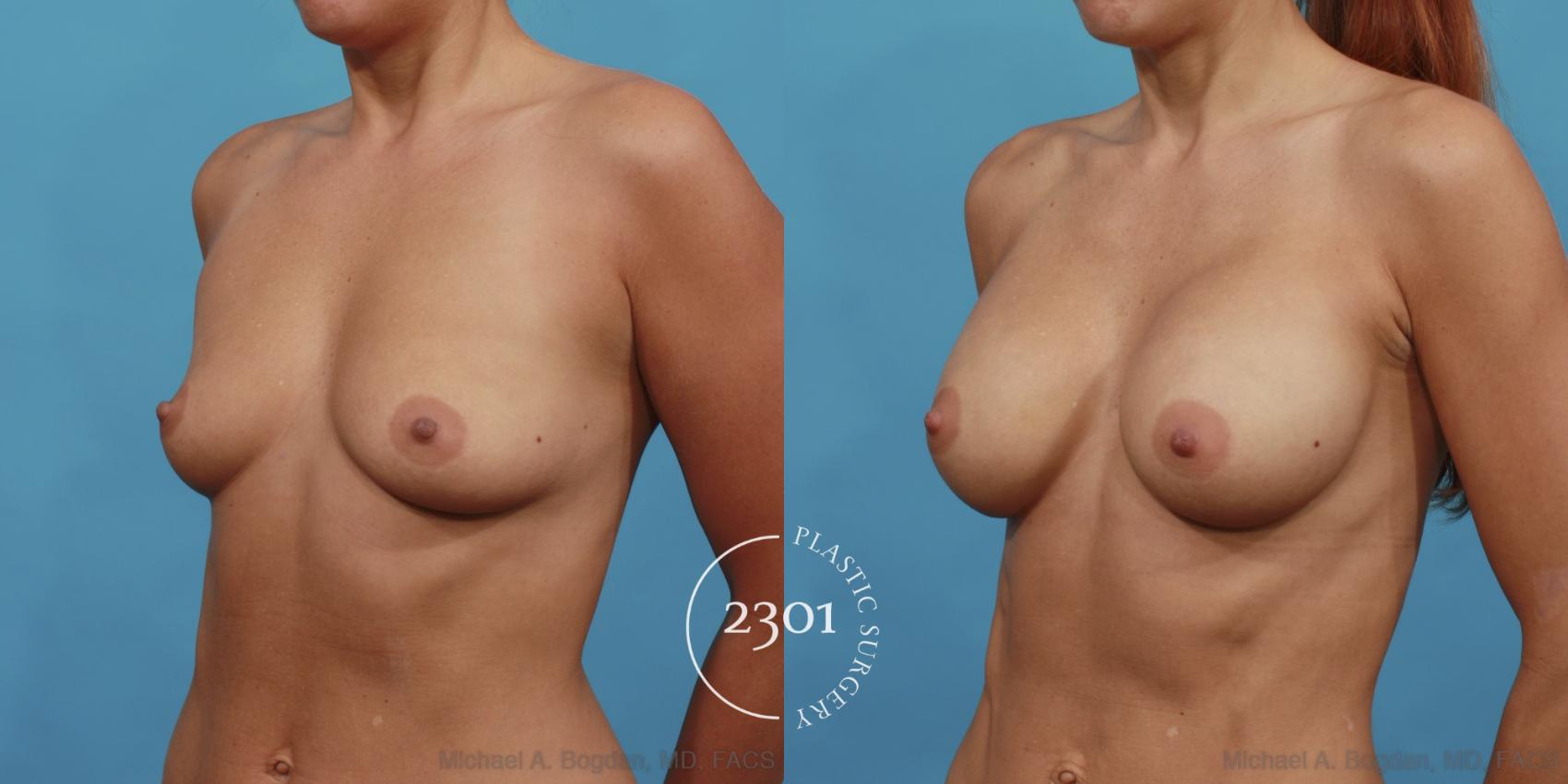Before & After Silicone Implants Case 494 View #2 View in Fort Worth, Plano, & Frisco, Texas