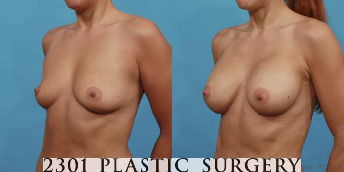 Before & After Breast Augmentation Case 494 View #2 View in Fort Worth, Plano, & Frisco, Texas