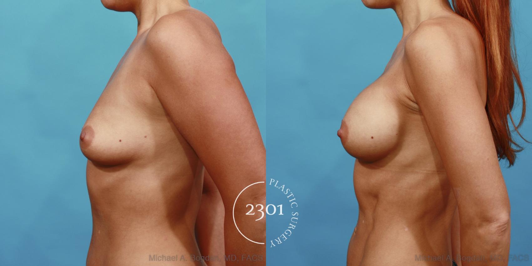 Before & After Silicone Implants Case 494 View #3 View in Fort Worth, Plano, & Frisco, Texas
