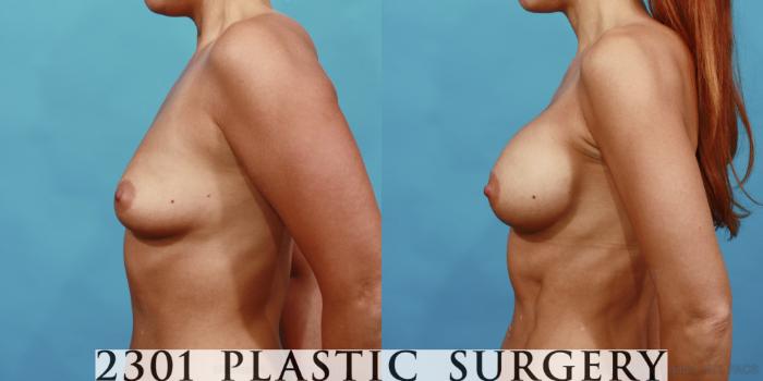 Before & After Silicone Implants Case 494 View #3 View in Fort Worth, Plano, & Frisco, Texas