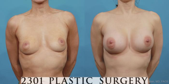 Before & After Silicone Implants Case 496 View #1 View in Fort Worth, Plano, & Frisco, Texas