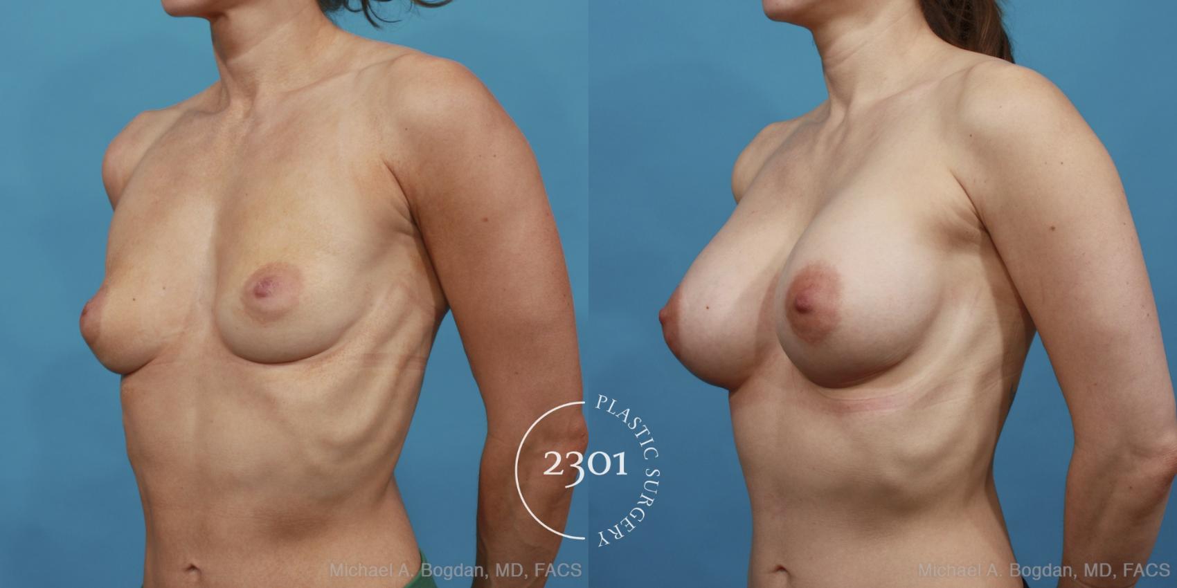 Before & After Silicone Implants Case 496 View #2 View in Fort Worth, Plano, & Frisco, Texas