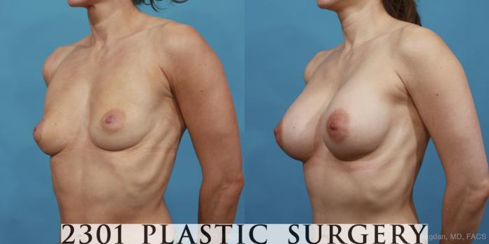 Before & After Silicone Implants Case 496 View #2 View in Fort Worth, Plano, & Frisco, Texas