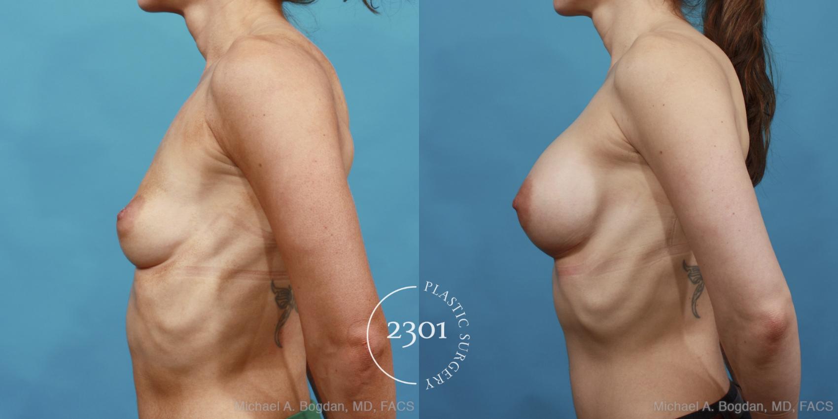 Before & After Silicone Implants Case 496 View #3 View in Fort Worth, Plano, & Frisco, Texas