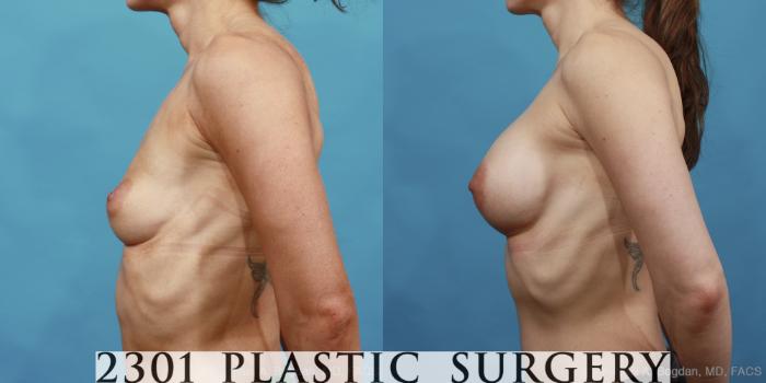 Before & After Silicone Implants Case 496 View #3 View in Fort Worth, Plano, & Frisco, Texas