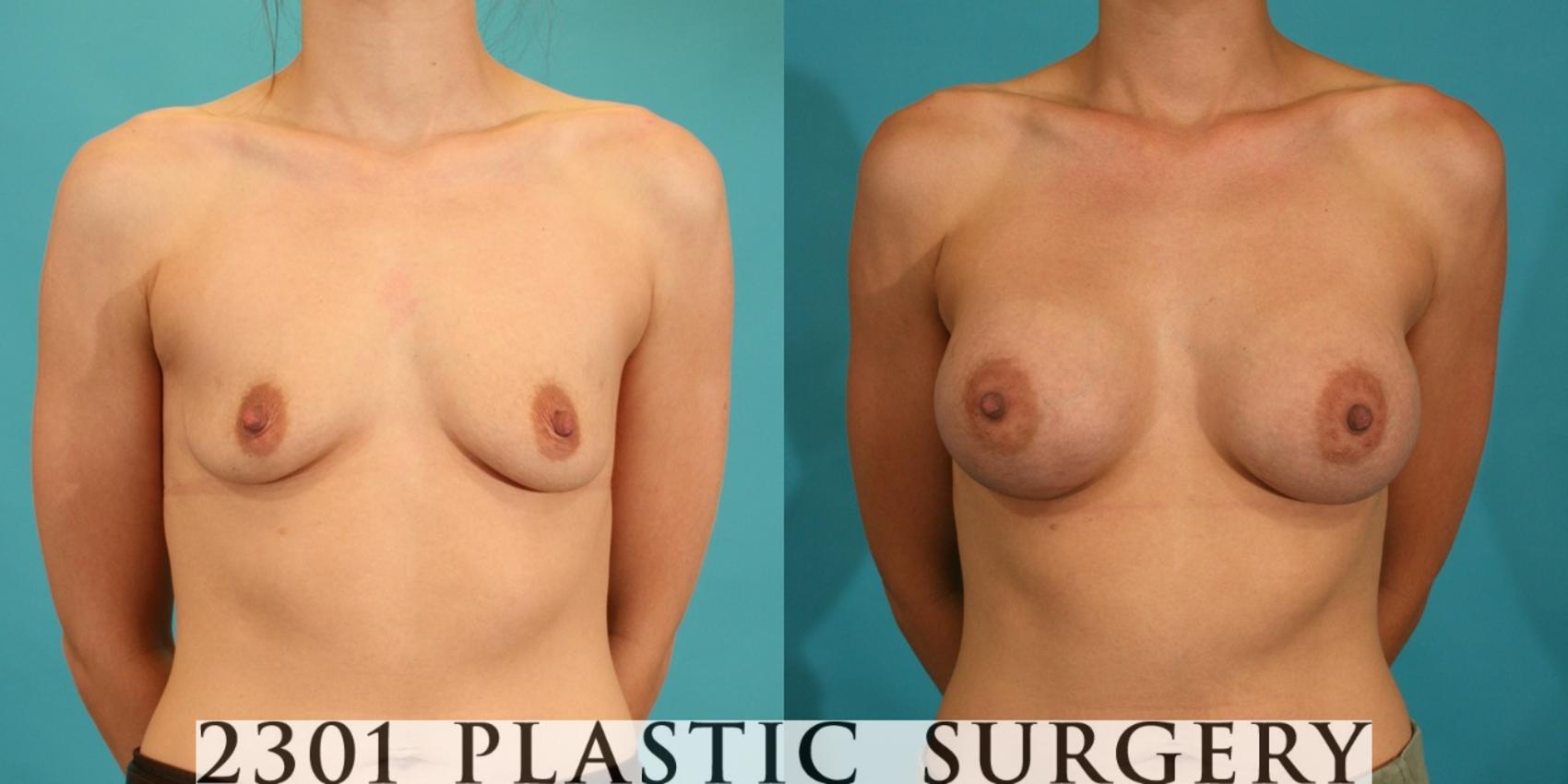 Before & After Silicone Implants Case 5 View #1 View in Fort Worth, Plano, & Frisco, Texas