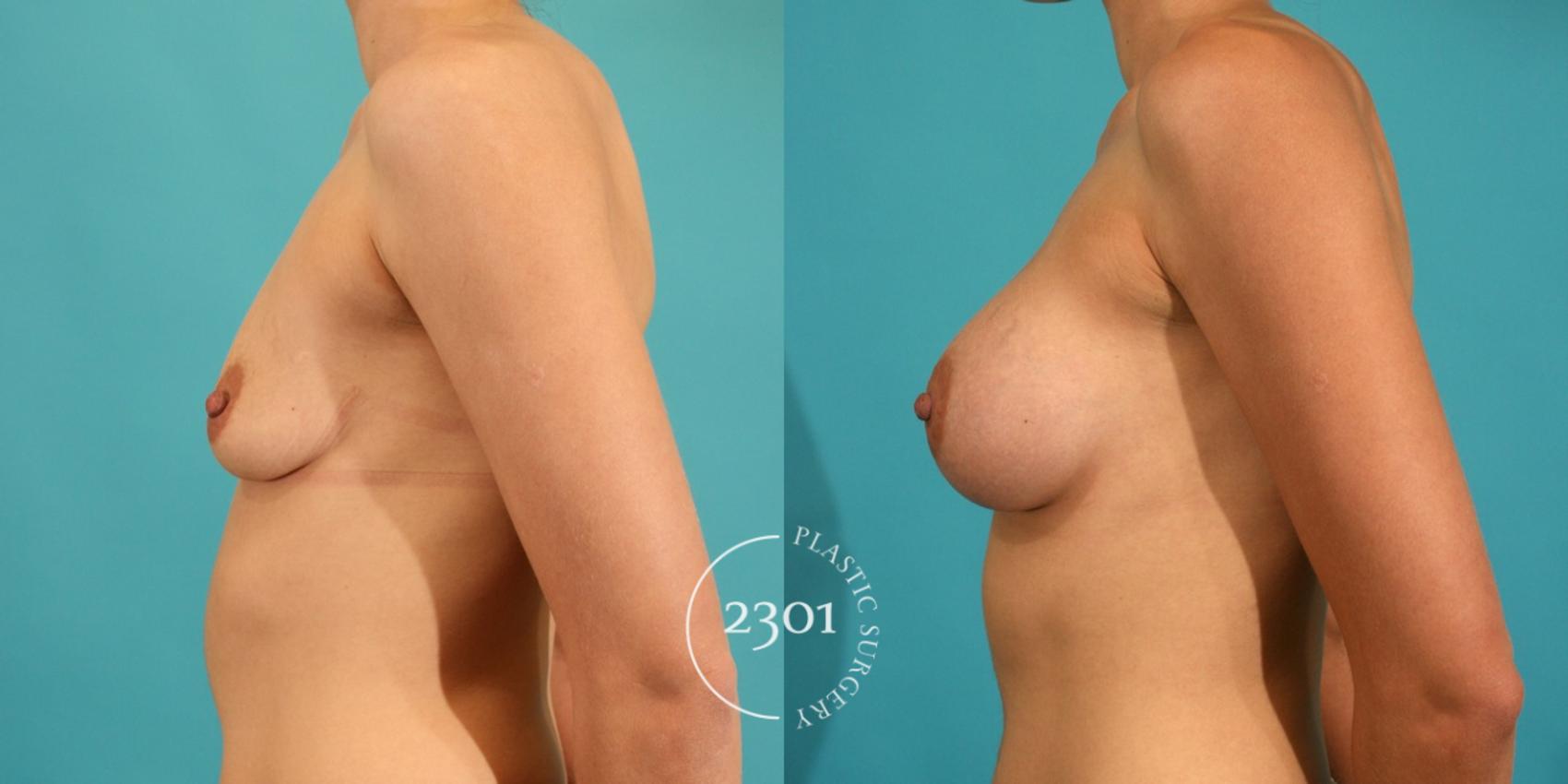 Before & After Silicone Implants Case 5 View #2 View in Fort Worth, Plano, & Frisco, Texas