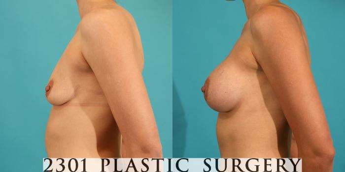 Before & After Silicone Implants Case 5 View #2 View in Fort Worth, Plano, & Frisco, Texas