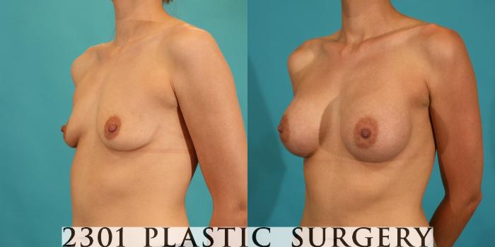 Before & After Silicone Implants Case 5 View #3 View in Fort Worth, Plano, & Frisco, Texas