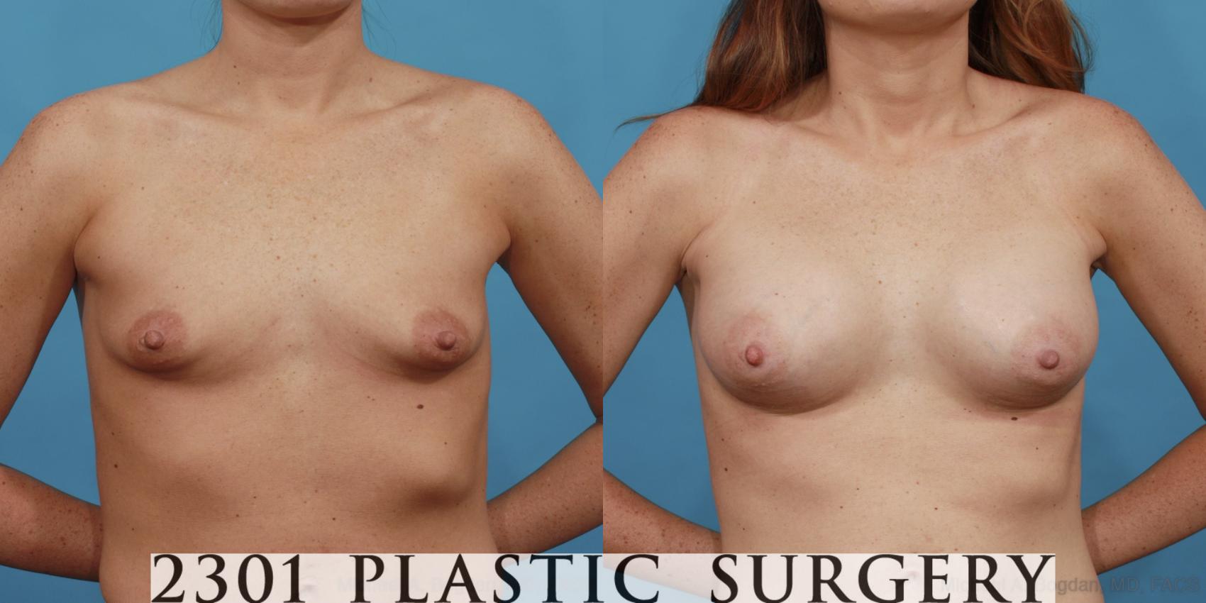 Before & After Silicone Implants Case 507 View #1 View in Fort Worth, Plano, & Frisco, Texas